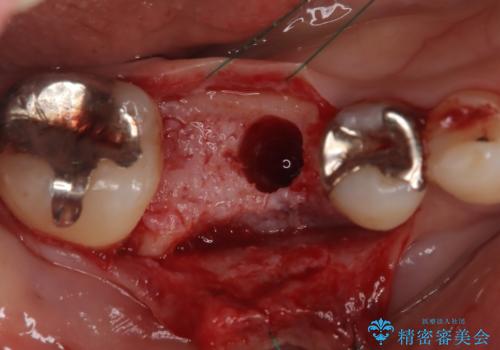 虫歯で失ってしまった奥歯、インプラント治療で再び噛めるように!の治療中