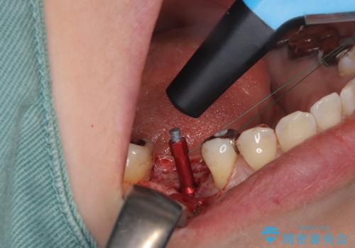 虫歯で失ってしまった奥歯、インプラント治療で再び噛めるように!の治療中