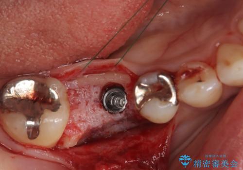 虫歯で失ってしまった奥歯、インプラント治療で再び噛めるように!の治療中