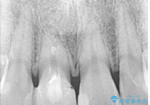 不自然な前歯の被せものをやり替えたいの治療前