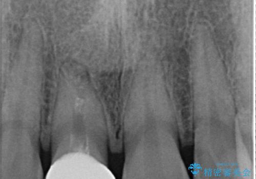 不自然な前歯の被せものをやり替えたいの治療後