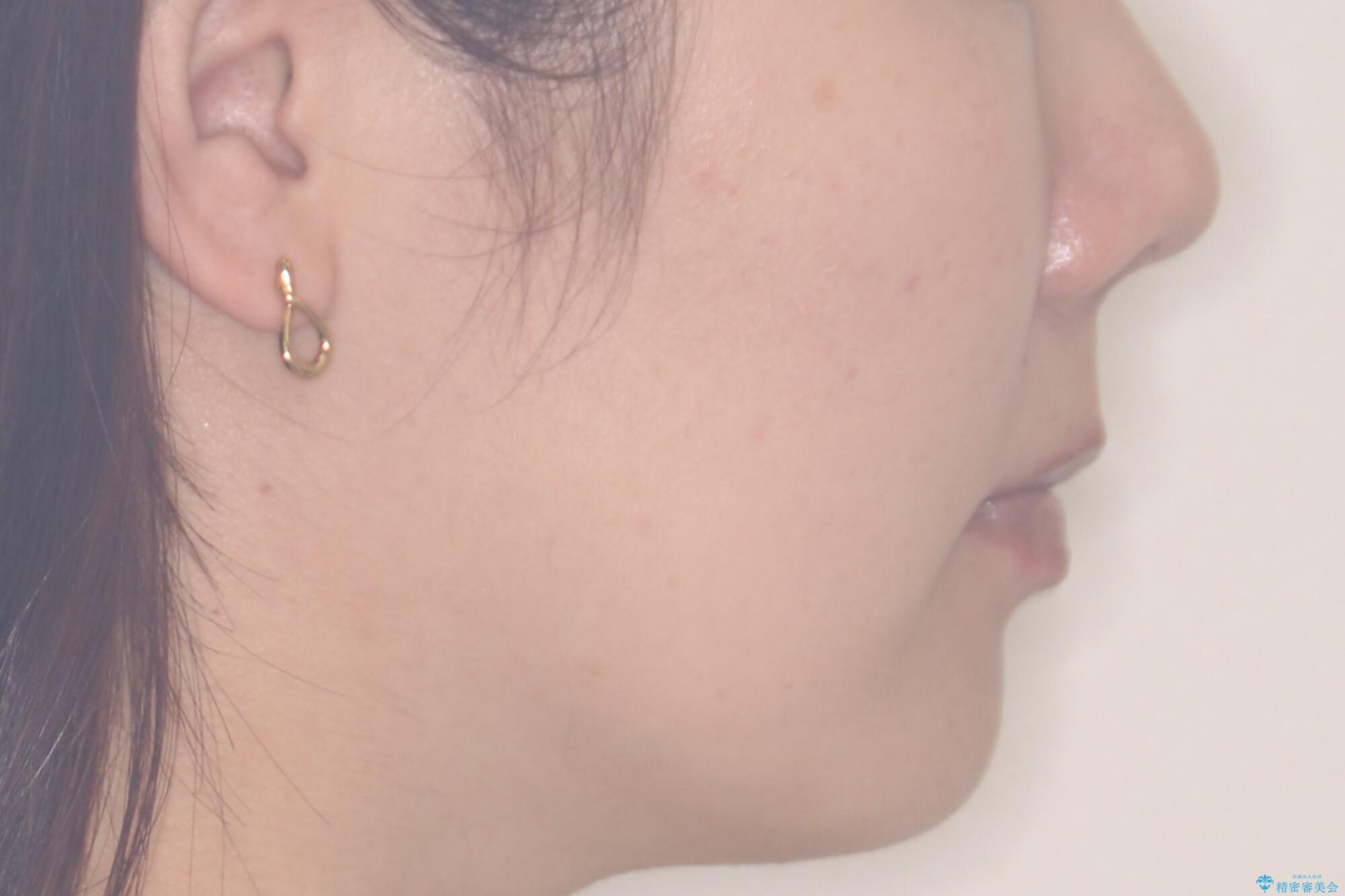【審美装置】前歯のがたがたを治したいの治療後(顔貌)