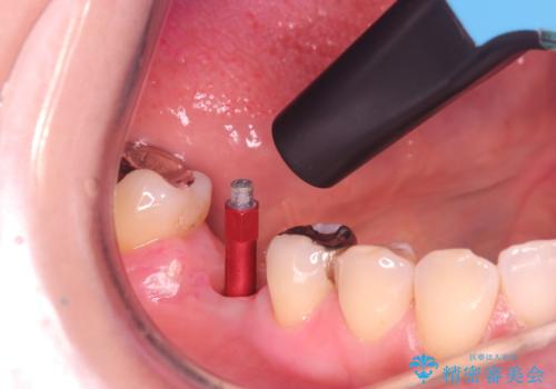 虫歯で失ってしまった奥歯、インプラント治療で再び噛めるように!の治療中