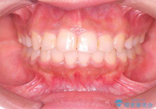 【審美ワイヤー】重度の叢生を治療の症例 治療後