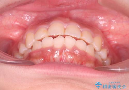 【審美ワイヤー】重度の叢生を治療の治療後