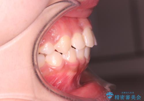 【審美ワイヤー】重度の叢生を治療の治療後