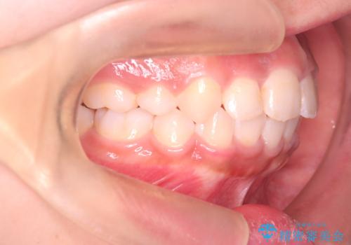 【審美ワイヤー】重度の叢生を治療の治療後