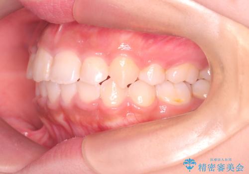 【審美ワイヤー】重度の叢生を治療の治療後