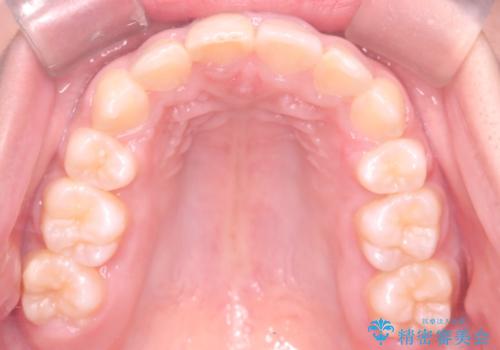 【審美ワイヤー】重度の叢生を治療の治療後