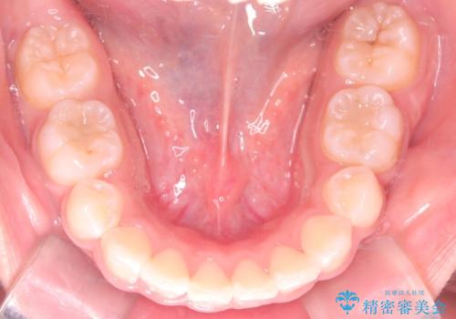 【審美ワイヤー】重度の叢生を治療の治療後