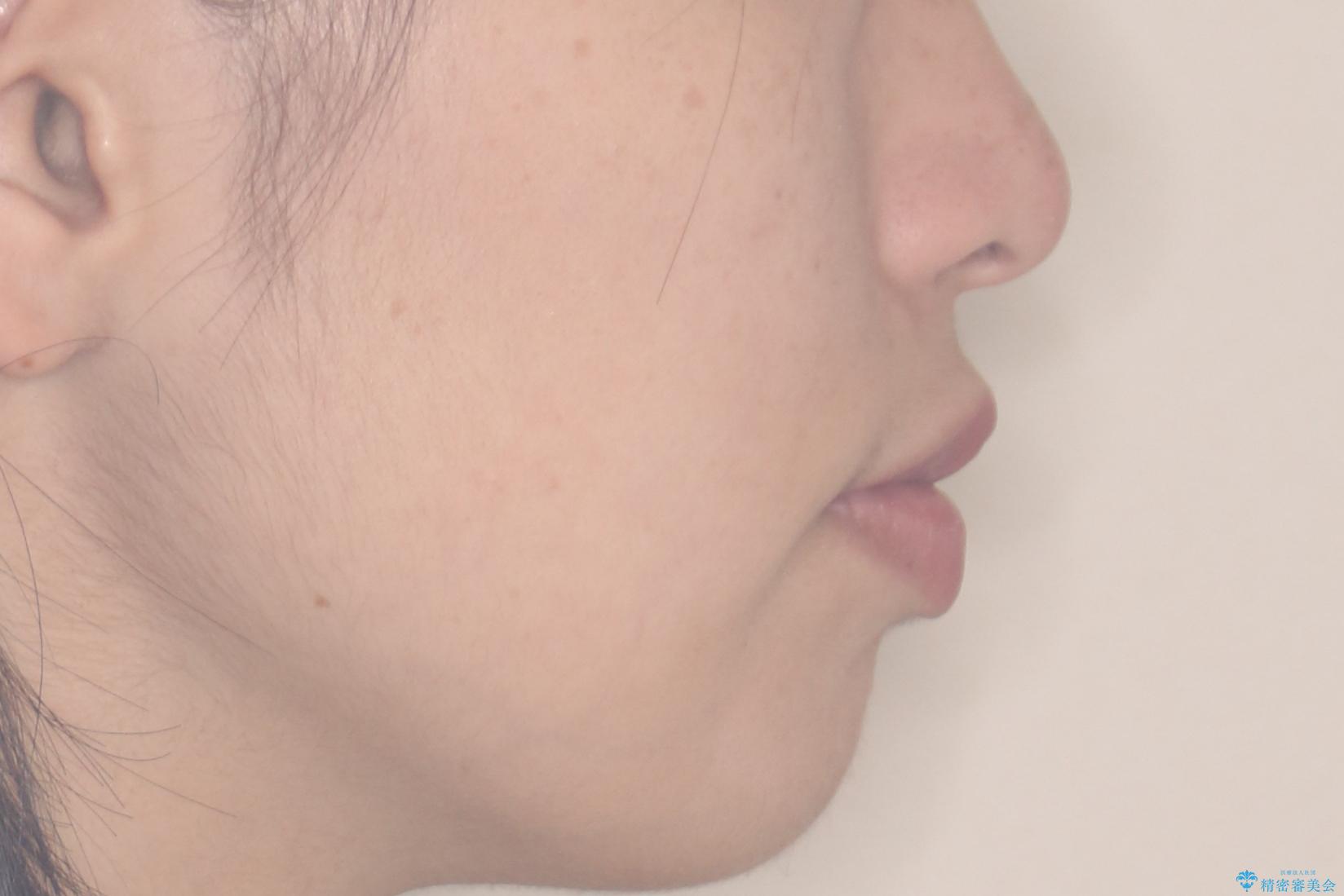 【審美ワイヤー】重度の叢生を治療の治療後(顔貌)