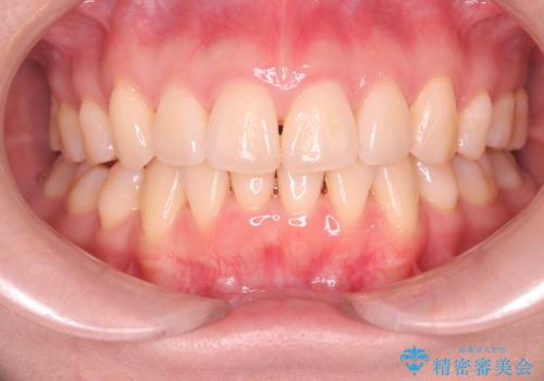 【インビザライン】抜歯矯正で口元も改善