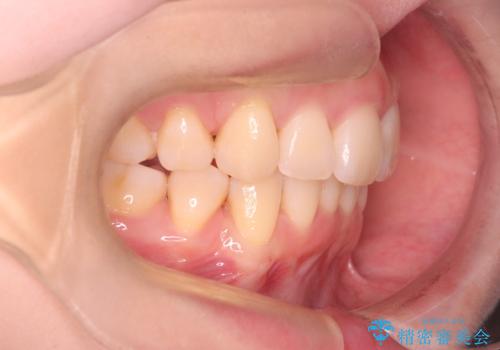 【インビザライン】抜歯矯正で口元も改善の治療後