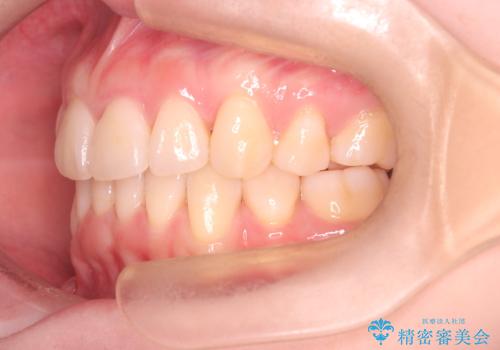 【インビザライン】抜歯矯正で口元も改善の治療後