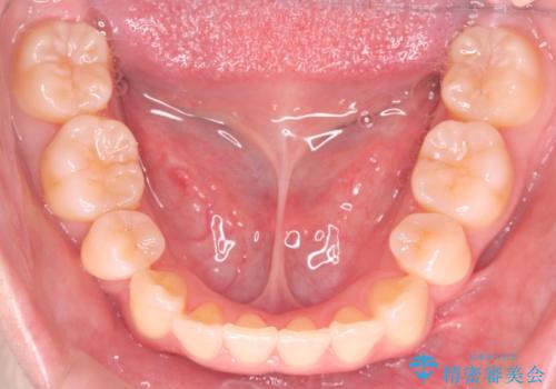 【インビザライン】抜歯矯正で口元も改善の治療後