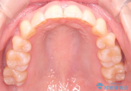 【インビザライン】抜歯矯正で口元も改善の治療後