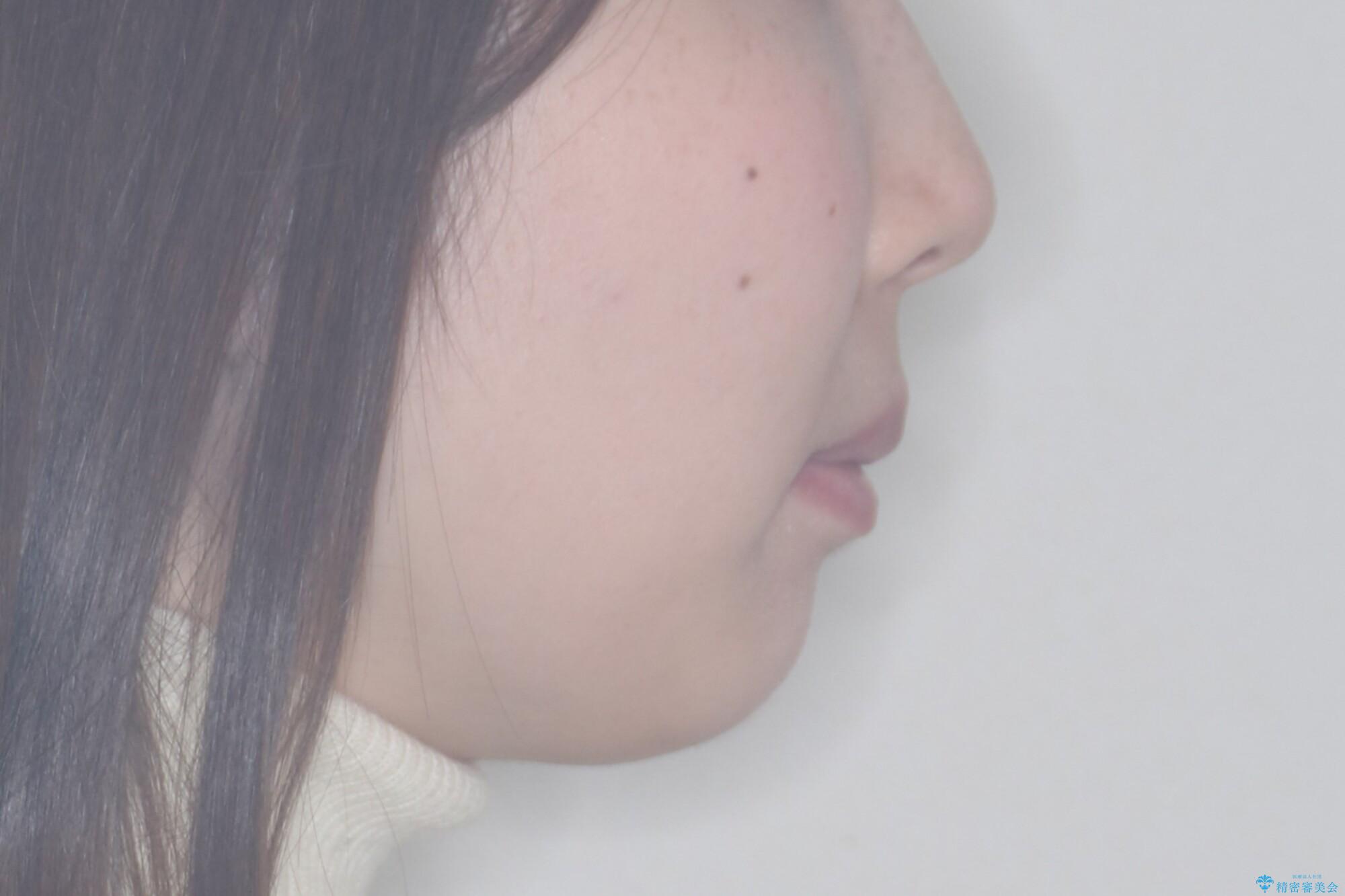 【インビザライン】抜歯矯正で口元も改善の治療後(顔貌)