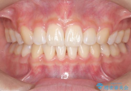 裏側矯正で口元をすっきりとした印象へ!の症例 治療後
