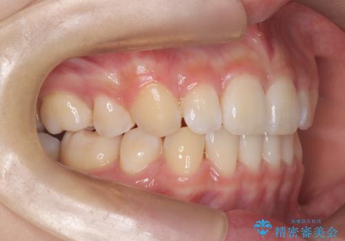 裏側矯正で口元をすっきりとした印象へ!の治療後