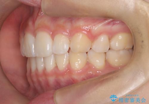 裏側矯正で口元をすっきりとした印象へ!の治療後