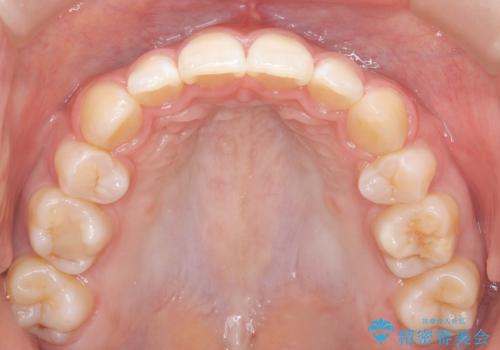 裏側矯正で口元をすっきりとした印象へ!の治療後