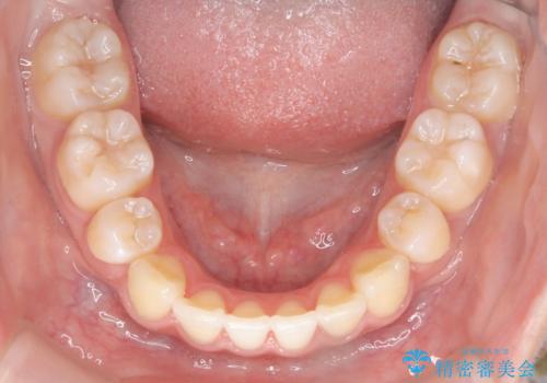 裏側矯正で口元をすっきりとした印象へ!の治療後