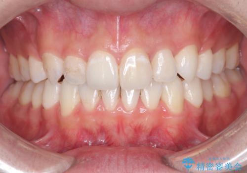 【インビザライン】抜歯矯正で前歯を下げたい。の治療後