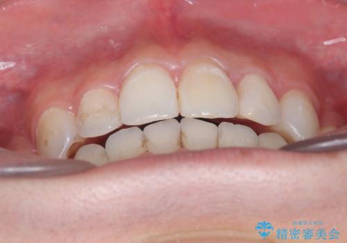 【インビザライン】抜歯矯正で前歯を下げたい。の治療後