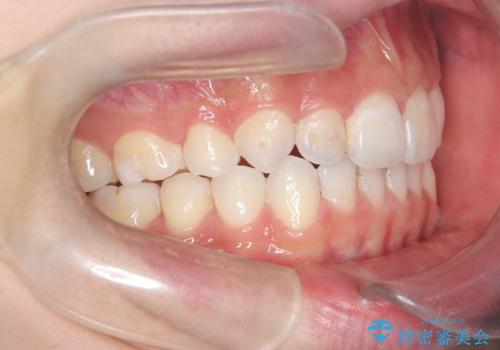 【インビザライン】抜歯矯正で前歯を下げたい。の治療後