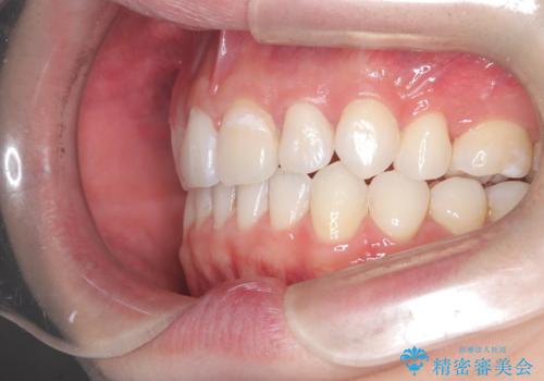 【インビザライン】抜歯矯正で前歯を下げたい。の治療後
