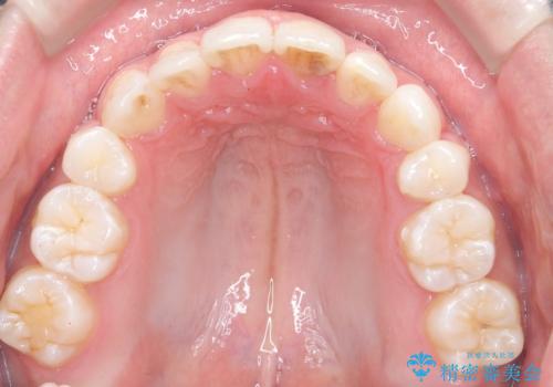 【インビザライン】抜歯矯正で前歯を下げたい。の治療後