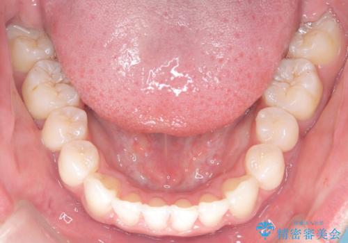 【インビザライン】抜歯矯正で前歯を下げたい。の治療後