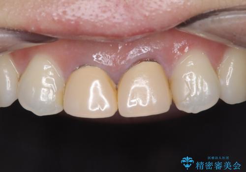 【審美修復】被せ物のみの治療の症例 治療前