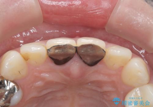 【審美修復】被せ物のみの治療の治療前