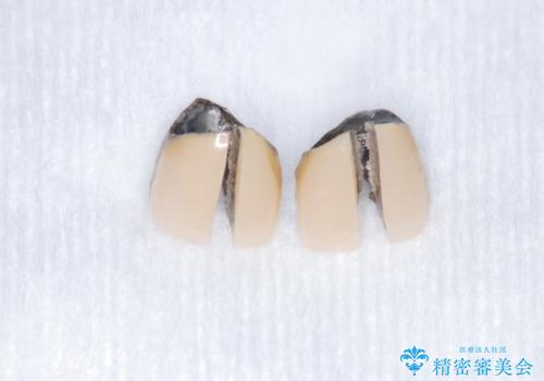 【審美修復】被せ物のみの治療の治療中