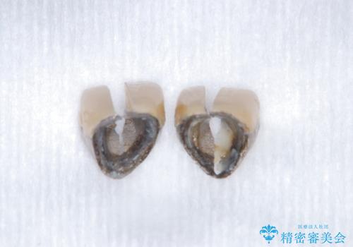 【審美修復】被せ物のみの治療の治療中