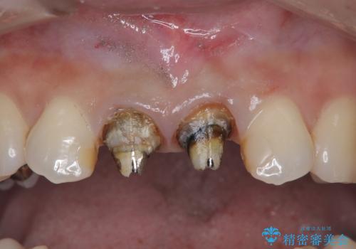 【審美修復】被せ物のみの治療の治療中