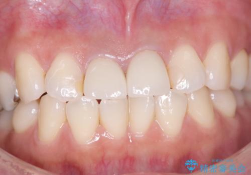 【審美修復】被せ物のみの治療の治療後