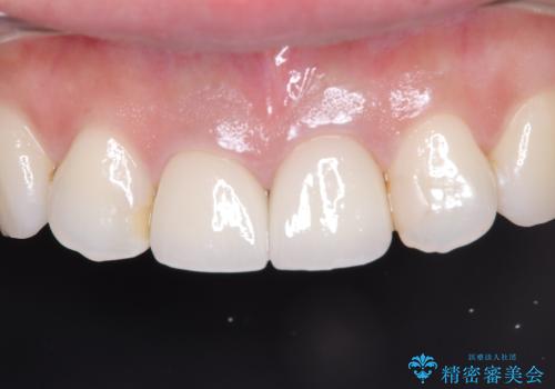 【審美修復】被せ物のみの治療