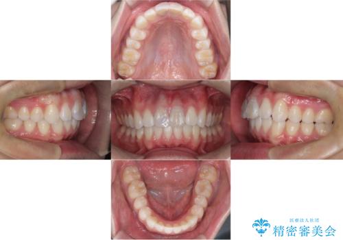 【ワイヤー矯正 11ヵ月で矯正終了!】歯のでこぼこを治したい! の治療後