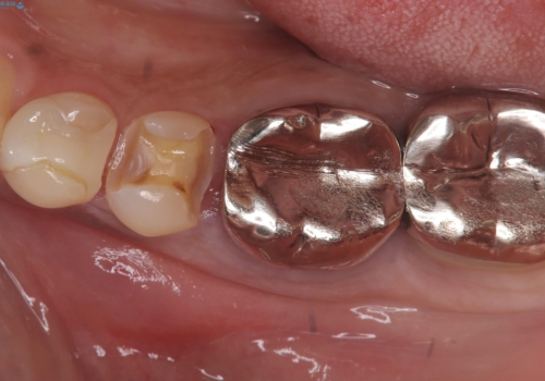【セラミックインレー】銀の詰め物を白くしていきたいの治療中
