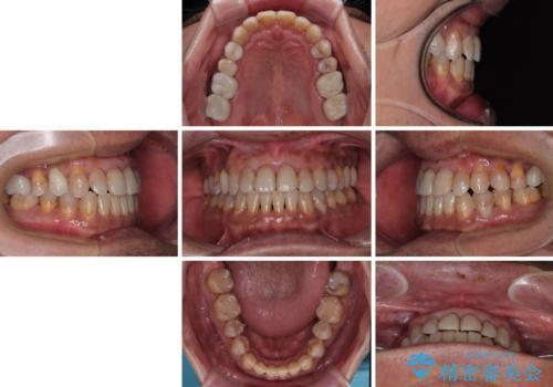 今からでも綺麗な歯並びを手に入れたい 40代男性のワイヤー矯正の治療後