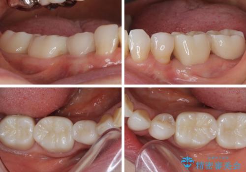 奥歯の目立つ銀歯をセラミックに オールセラミッククラウン治療の治療後