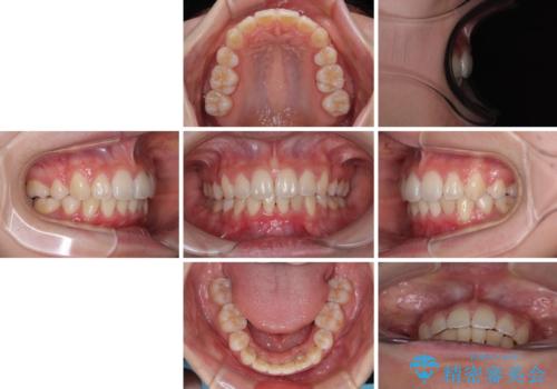 飛び出した上顎前歯 ワイヤー装置にて抜歯矯正治療の治療後
