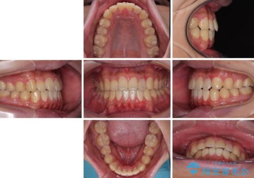 クロスバイトを楽して治す ワイヤー装置にて矯正治療の治療後