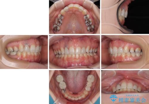 飛び出した上顎前歯とむし歯の多い歯列 目立たないハーフリンガル矯正とむし歯治療の治療後