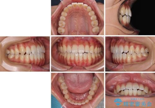八重歯とオープンバイト 急速拡大装置を用いた矯正治療の治療後