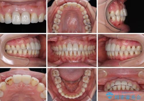 隙間をセラミックで閉じたら不格好で歯肉から出血 矯正治療と歯周外科で綺麗な前歯にの治療後