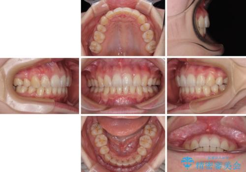 飛び出した上顎前歯 抜歯矯正でスッキリとした横顔にの治療後