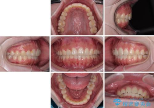 前歯のデコボコをインビザラインできれいに整えるの治療後